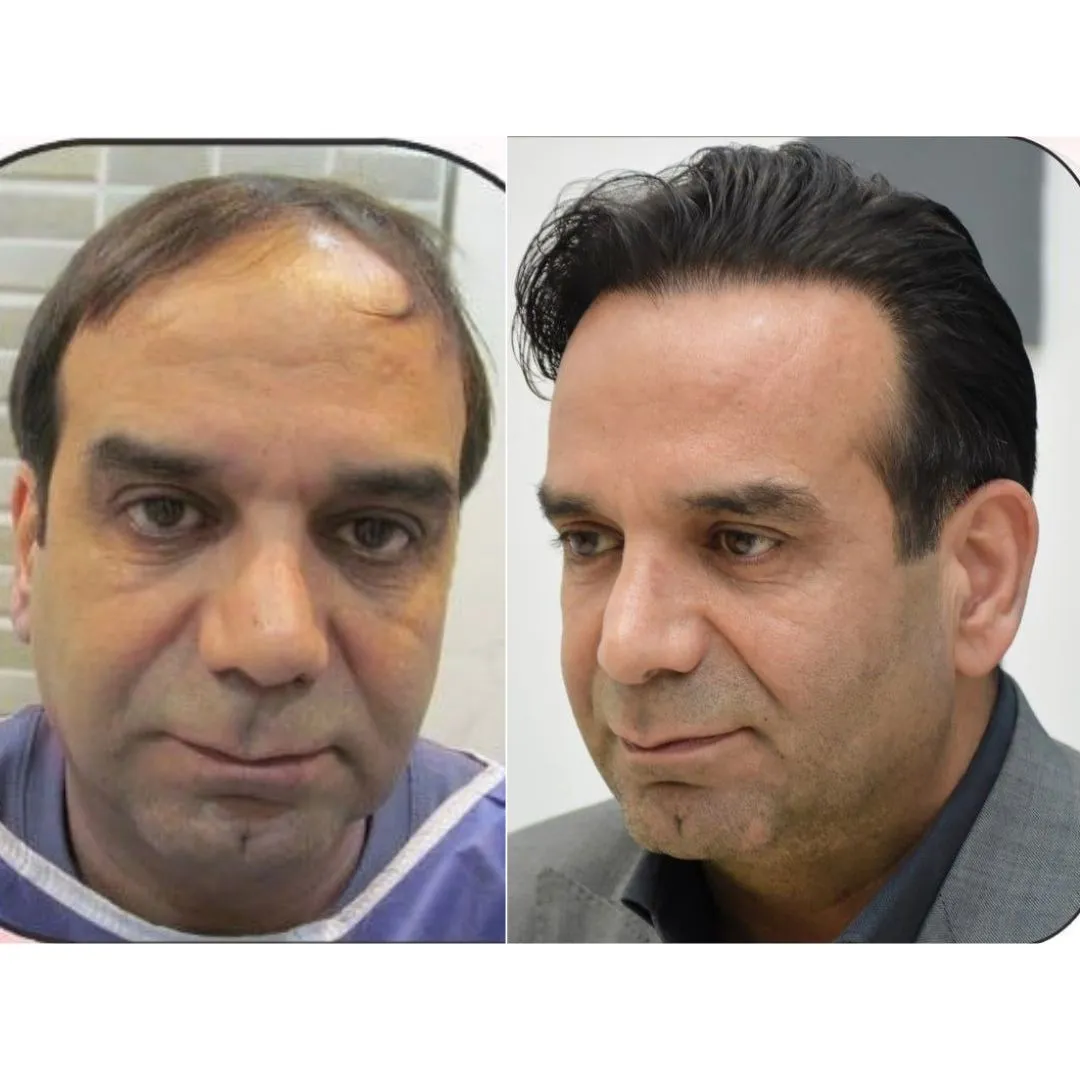 قبل و بعد کاشت مو